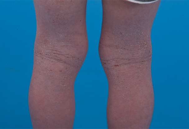 Photo of eczema on back of the knees