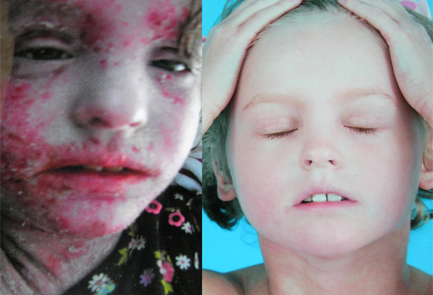Before and after photo comparison of the same boy shows improvements after eczema treatment at NIH.