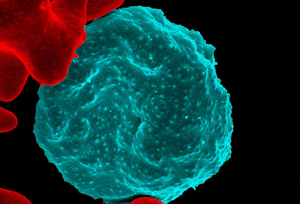 Colorized scanning electron micrograph of red blood cell infected with malaria parasites, which are colorized in blue.