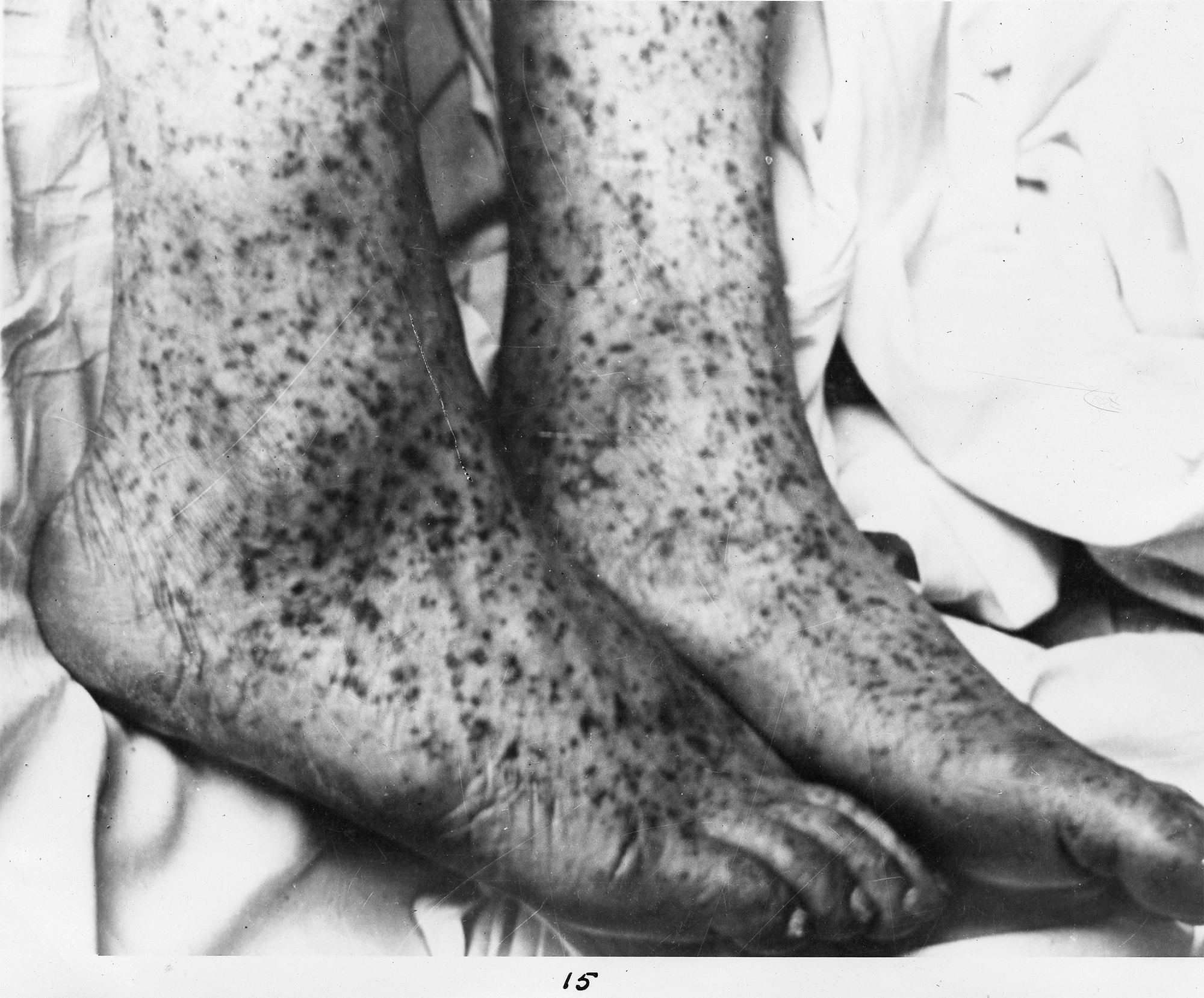 The “black measles” rash characteristic of later stages of spotted fever infection.