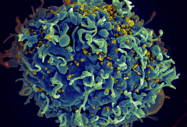 An HIV-infected immune cell.