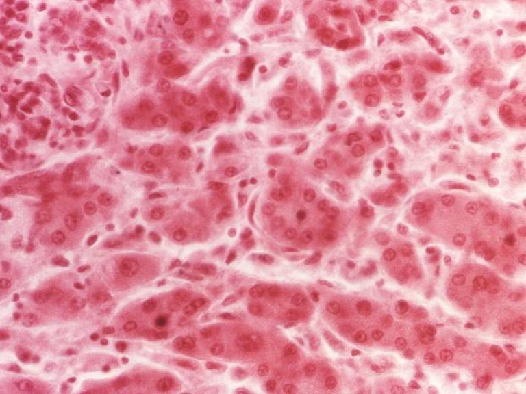 Photo of liver tissue specimen extracted from a viral hepatitis patient.