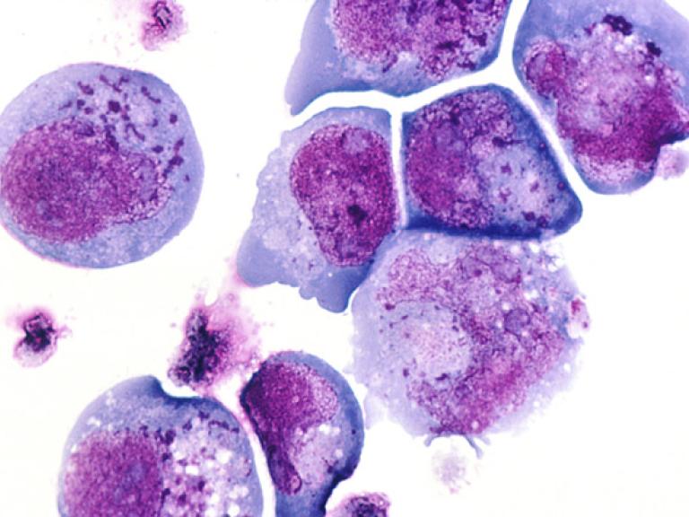 Photomicrograph of cells infected with human herpesvirus 6.