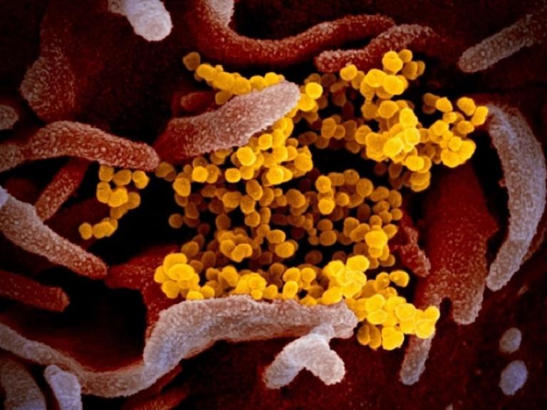 scanning electron microscope image shows SARS-CoV-2 (yellow)