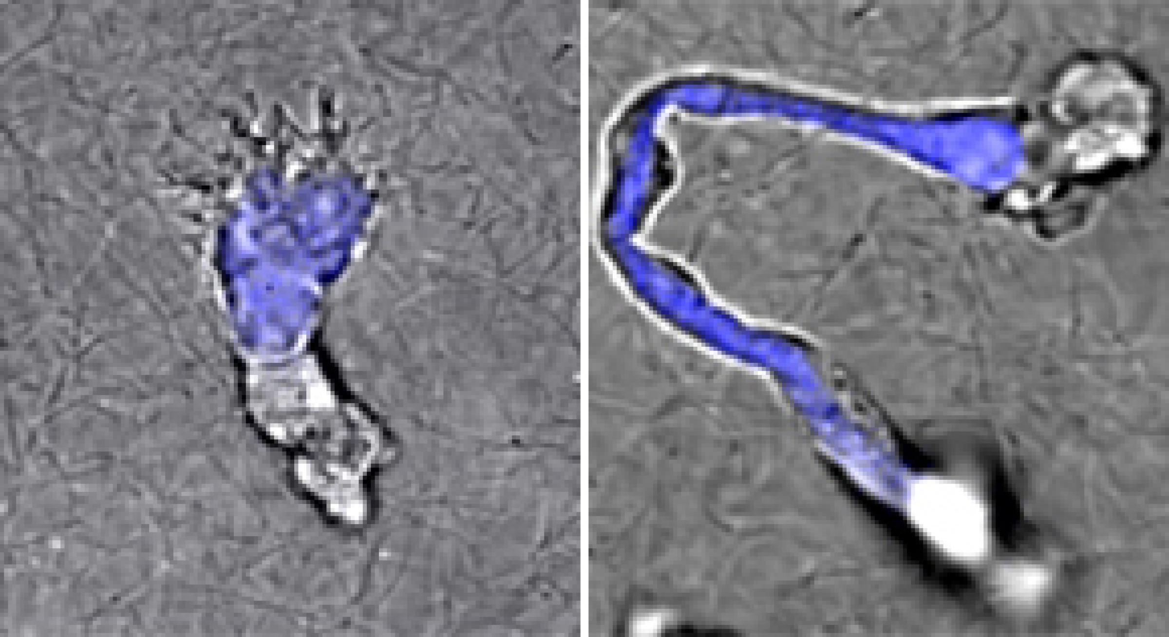 Image of T cells from a healthy donor compared to a DOCK8-deficient patient.