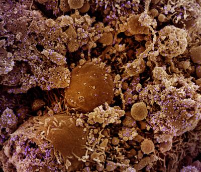 This colorized scanning electron micrograph shows chronically infected and partially lysed cells (brown) infected with a variant strain of SARS-CoV-2 virus particles (purple), isolated from a patient sample. SARS-CoV-2 is the virus that causes COVID-19.