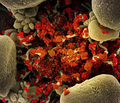 Colorized scanning electron micrograph of an apoptotic cell (tan) heavily infected with SARS-COV-2 virus particles (orange).