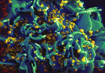 Scanning electron micrograph of a human H9 T cell infected with HIV virus particles.