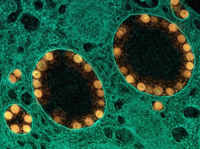 A transmission electron micrograph of SARS-CoV-2 virus particles (colored gold) within the endosomes of a heavily infected nasal olfactory epithelial cell. 