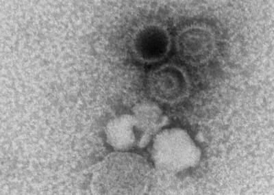An electron microscopy image showing three Epstein-Barr virions.