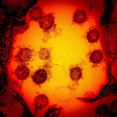 Transmission electron micrograph of SARS-CoV-2 virus particles, isolated from a patient.