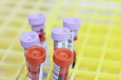 Photo of blood samples in test tubes.