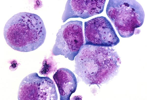 Photomicrograph of cells infected with human herpesvirus 6.