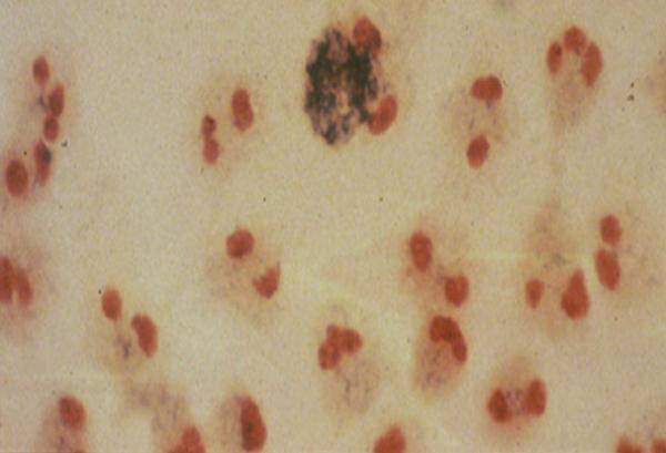 Neutrophils from the blood of a patient with CGD.