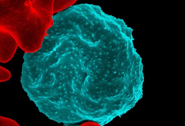 Colorized scanning electron micrograph of red blood cell infected with malaria parasites, which are colorized in blue.