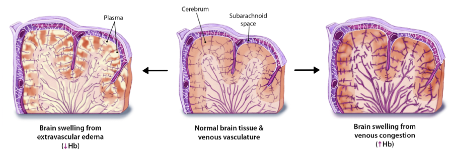 Three illustrations depicting, from left to right, a brain that swollen from too much fluid surrounding it (edema), a normal brain, and a brain that is swollen from having too much blood in its veins.