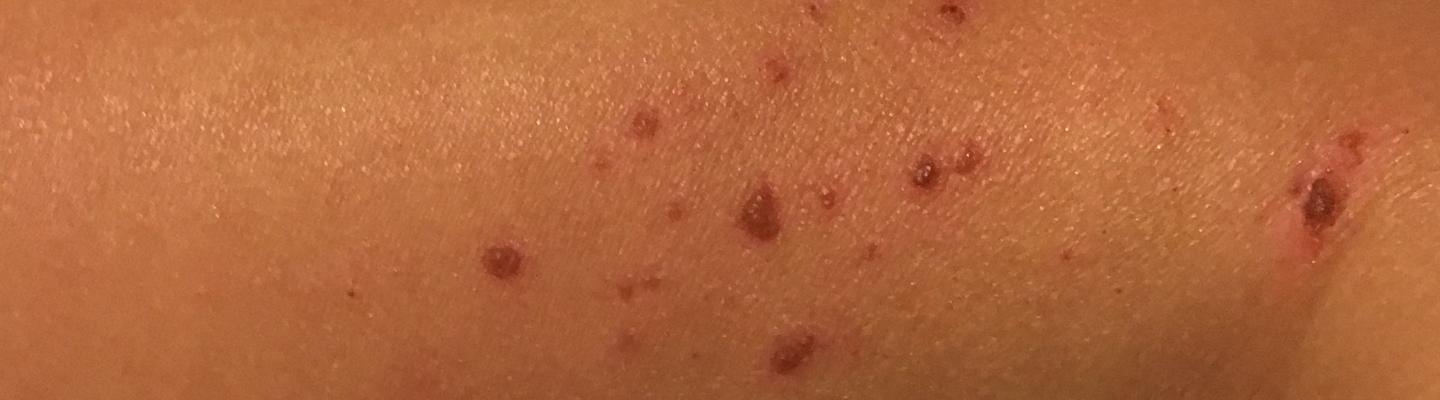 Image of eczema on skin