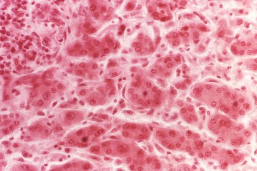Photo of liver tissue specimen extracted from a viral hepatitis patient.