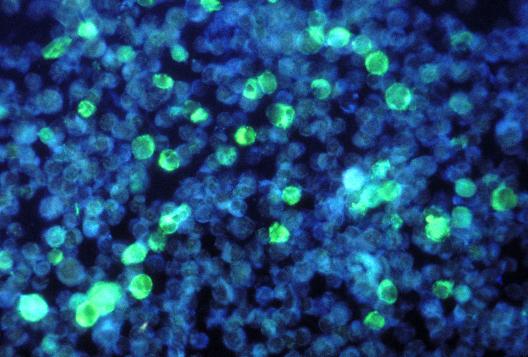 Primary Immune Deficiency Diseases (PIDDs) 