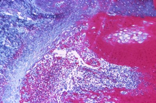 Smallpox image