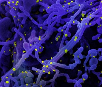 Colorized scanning electron micrograph of a cell (purple) infected with SARS-COV-2 virus particles (yellow), isolated from a patient sample.