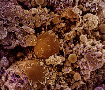 This colorized scanning electron micrograph shows chronically infected and partially lysed cells (brown) infected with a variant strain of SARS-CoV-2 virus particles (purple), isolated from a patient sample. SARS-CoV-2 is the virus that causes COVID-19.