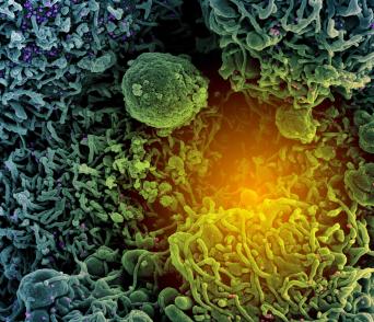 This colorized scanning electron micrograph shows a cell (teal and green) infected with SARS-CoV-2 virus particles (purple and pink) isolated from a patient sample.