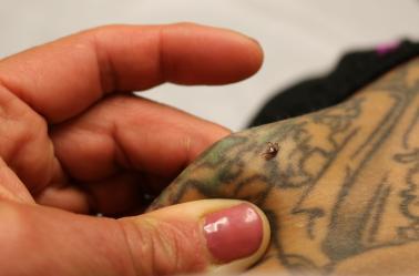 patient with tick bite