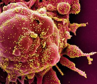 A scanning electron micrograph shows an apopototic cell heavily infected with SARS-CoV-2 virus particles