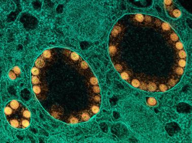 A transmission electron micrograph of SARS-CoV-2 virus particles (colored gold) within the endosomes of a heavily infected nasal olfactory epithelial cell.