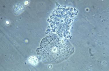 Photomicrograph of normal cell and bacteria-covered cell