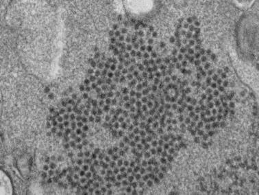 Enterovirus D68