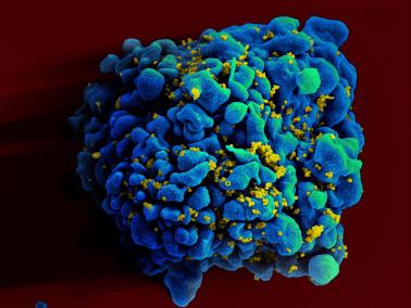 Scanning electromicrograph of an HIV-infected T cell