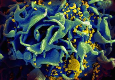 Microscopic image of an HIV-infected T cell.