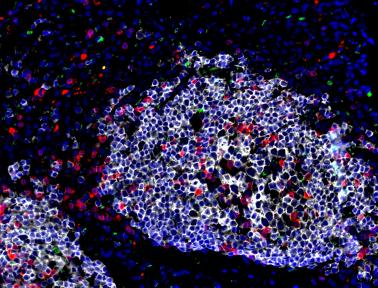 Innate lymphoid cells (green) near and within a small area of inflammation in a non-human primate infected with Mycobacterium tuberculosis, the bacteria that cause TB