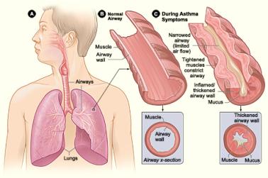 Illustration of key physiological differences between a normal lung airway and a lung airway in a person experiencing asthma symptoms.