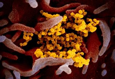 scanning electron microscope image shows SARS-CoV-2 (yellow)
