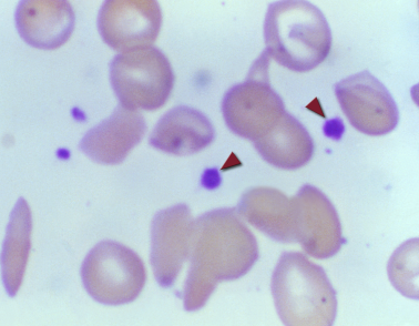 Microscopic image showing small, spiky platelets among larger, round red blood cells
