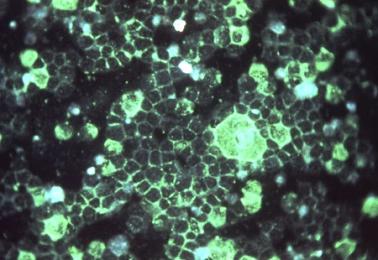 Respiratory Syncytial Virus (RSV)