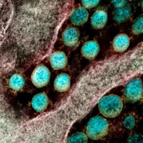 SARS-CoV-2 virus particles, colored blue in this image, isolated from a patient.