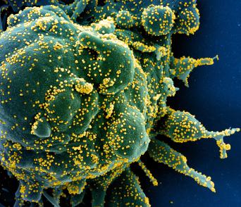 Colorized scanning electron micrograph of an apoptotic cell colored green, heavily infected with SARS-COV-2 virus particles, colored yellow