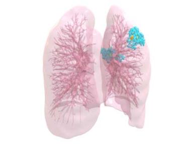 3D visualization of lungs and TB infection