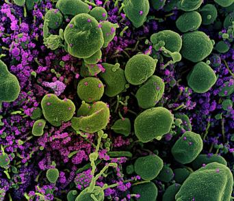 Colorized scanning electron micrograph of an apoptotic cell (green) heavily infected with SARS-COV-2 virus particles (purple)