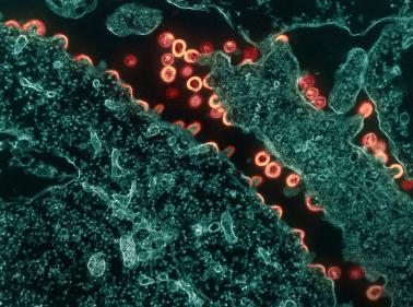 粉红色和棕褐色的 HIV-1 病毒颗粒从蓝绿色慢性感染的 H9 细胞片段中萌芽和复制。