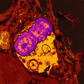 A human neutrophil is shown in red after ingesting Klebsiella pneumoniae bacteria, shown in purple.