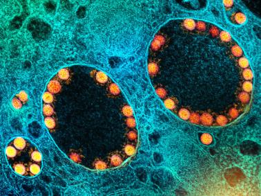 Transmission electron micrograph of SARS-CoV-2 virus particles (gold) within endosomes of a heavily infected nasal epithelial cell.