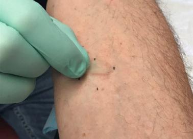 A researcher demonstrates the minimally invasive collection of skin samples using small, clear tape strips.