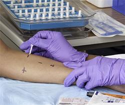 photo of someone receiving an allergy skin test