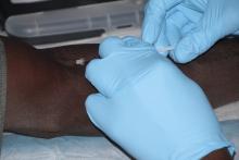An adult volunteer in Mali receives the experimental malaria vaccine known as PfSPZ Vaccine