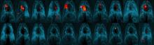 Images of animal lungs showing substantial areas of TB infection (top row) or very little or no infection (bottom row)